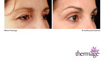 Thermage-Augen