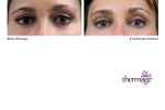 Thermage-Augen2