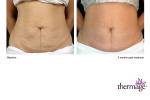 Thermage-Bauch2