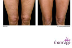 Thermage-Beine